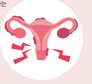 자궁내막증 증상 원인 총정리 자궁내막증 증상 원인 총정리
