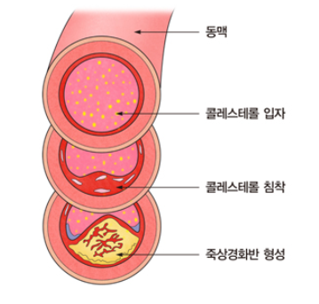 일과성 허혈발작