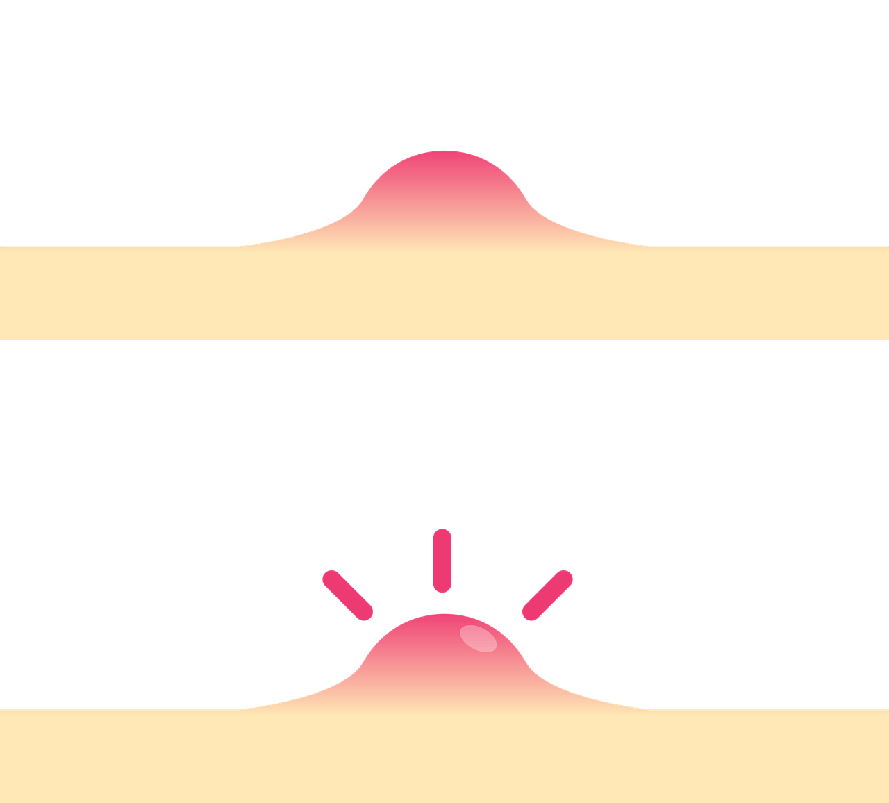 대상포진-전염성