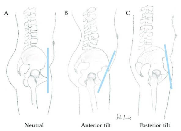 골반의 정렬을 보여주는 그림으로 가장 왼쪽은 정상 중간 부위는 골반이 전방회전 된 상태&#44; 가장 오른쪽 그림은 후방회전된 상태의그림을 보여줌