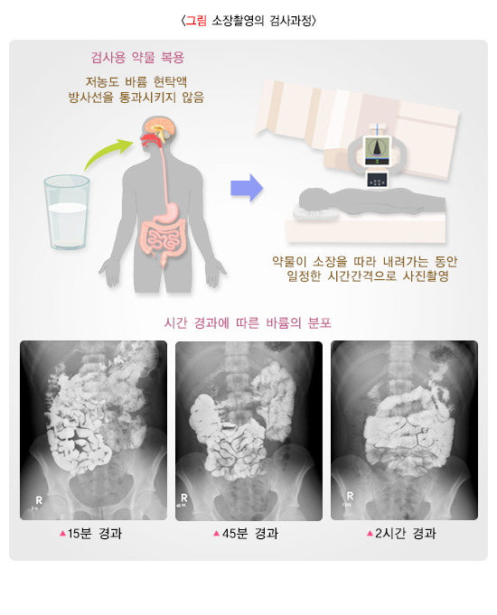 서ㅗ장촬영검사과정