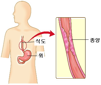 식도암