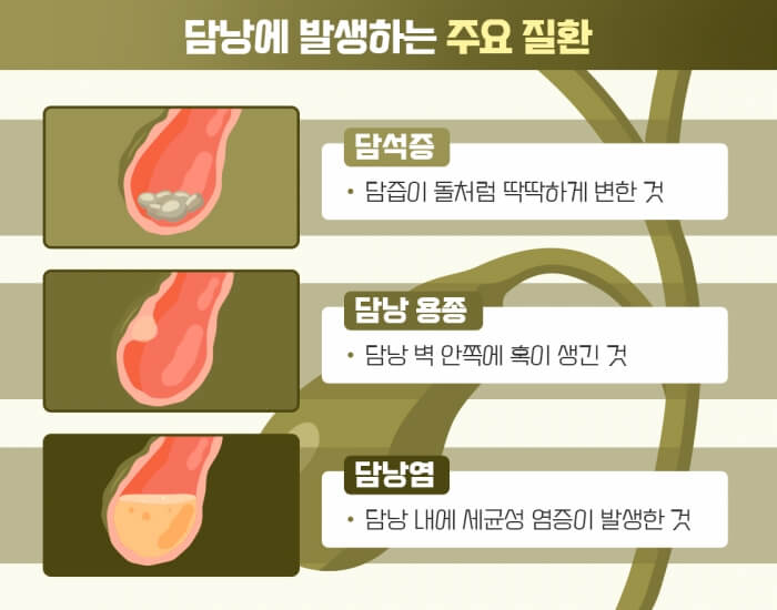 담낭제거수술-후유증-수술비용-관리-커피-먹지말아야하는음식