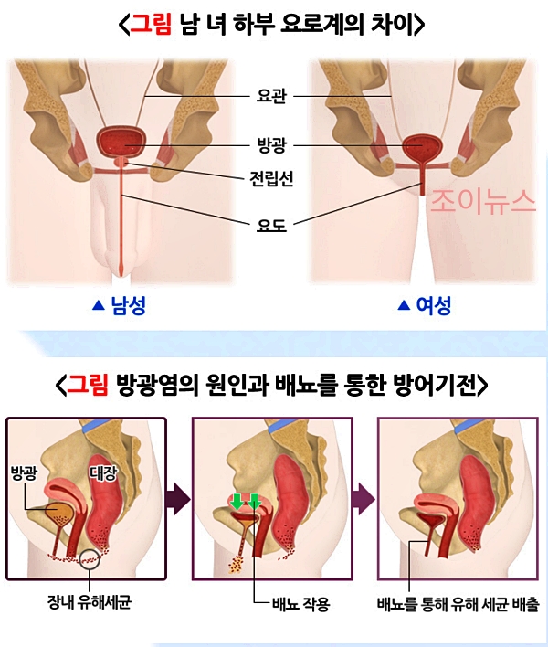 방광염 원인_출처:국가건강정보포털