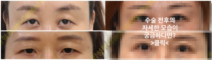 안검하수
