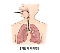 폐암 초기증상