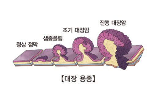  위 대장 용종과 선종이란? 발생 원인 및 제거 해야 하는 경우