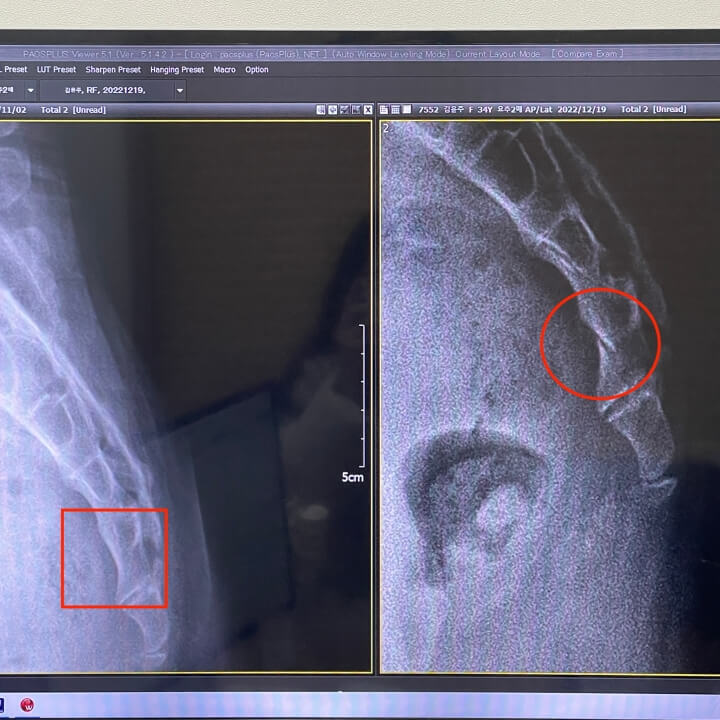 꼬리뼈-골절-엑스레이사진
