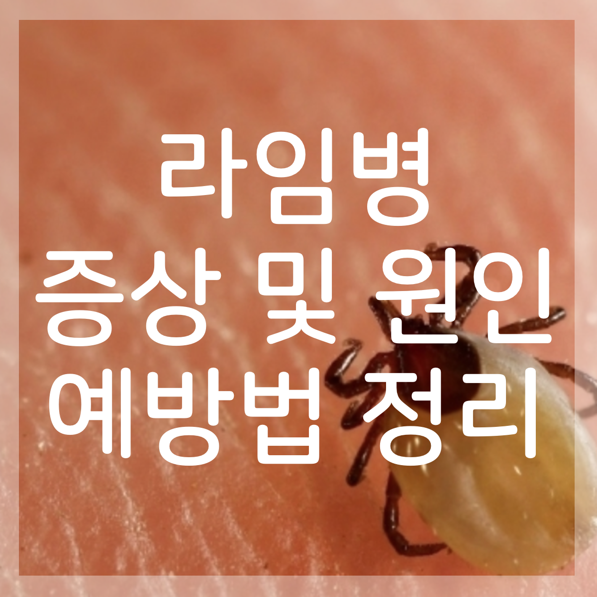  저스틴비버 투병 중으로 알려진 라임병 증상 원인 예방법 정리