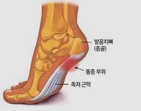 족저근막 및 통증 부위