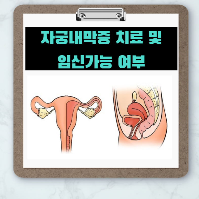  자궁 내막증 치료 및 임신가능여부