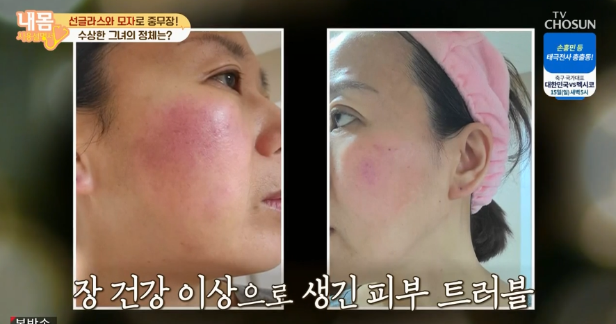  건선증상,원인,치료법(장피부건강지키는병아리콩효능)병아리콩비지찌개,시금치달걀찜,병아리콩당근어묵볶음파프리카구이 레시피 들기름팩만들기 요가 스킨케어유산균효능내몸사용설명서