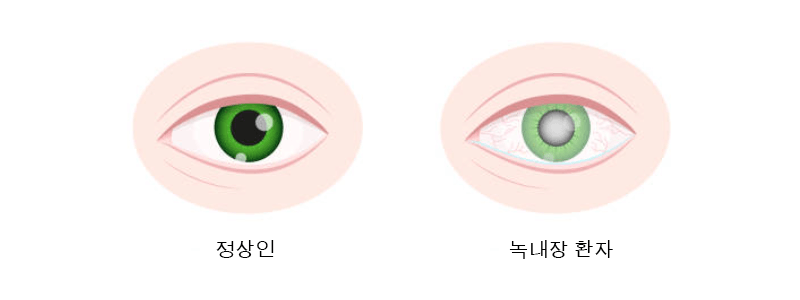 정상인눈-녹내장환자눈