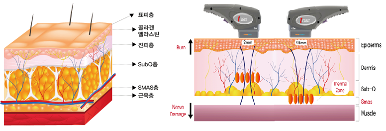 HIFU가 작용하는 진피층과 SMAS층을 확인할 수 있는 피부구조도와 작용모식도