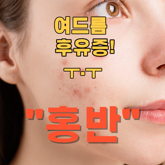 여드름 후유증으로 남은 홍반&#44; 효과적인 관리법은?