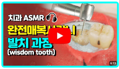 사랑니 뽑는 과정 완벽 공개