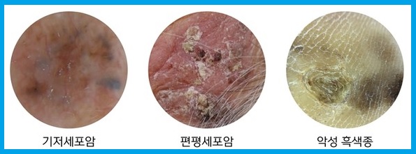 피부암 증상과 치료
