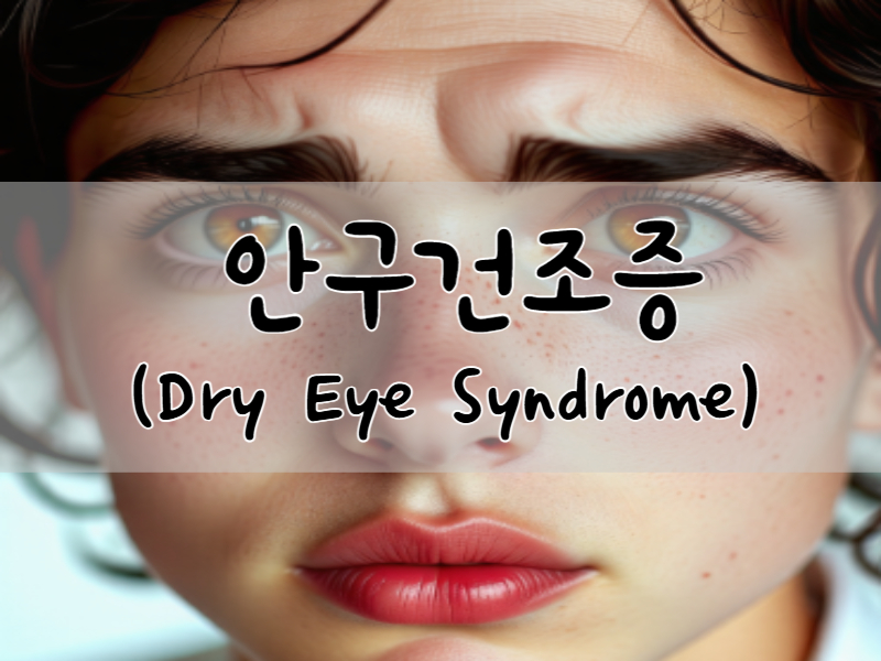 안구건조증(Dry Eye Syndrome): 원인, 증상, 진단 및 관리 방법