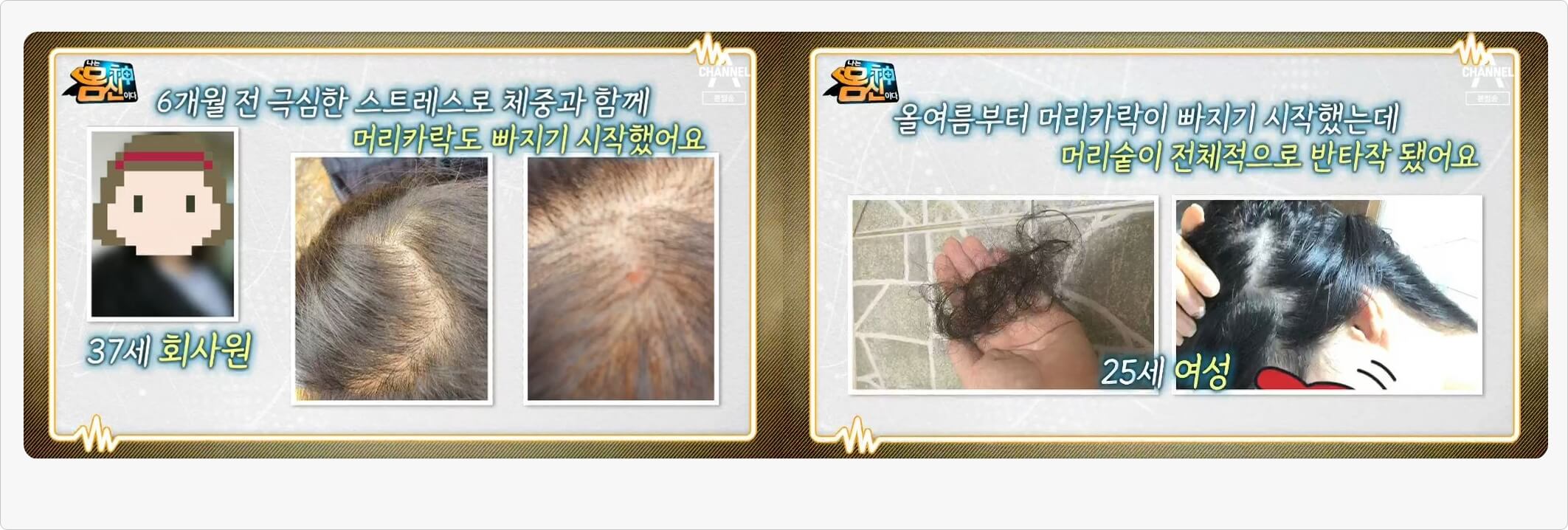 탈모 후유증