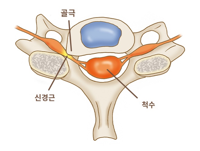  경추성 신경근증은 무엇이며 어떤증상이 있고 어떻게 치료할까 ?