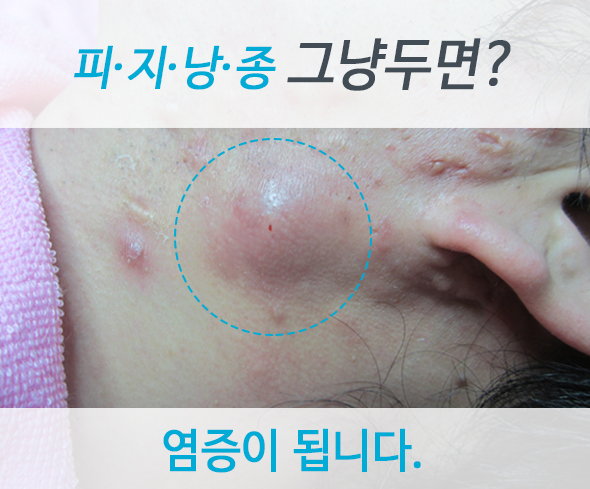 겨드랑이 피지낭종의 불쾌감이 커지는 경우
