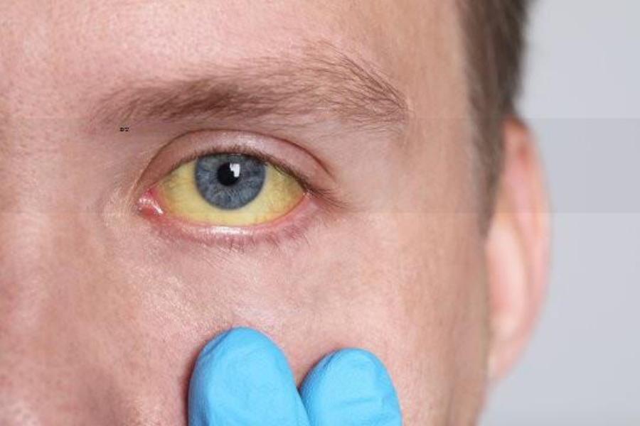 간질환의 하나인 황달을 앓고 있는 환자의 눈 흰자 부위가 노랗게 되어 있는 것을 확대하여 찍은 사진