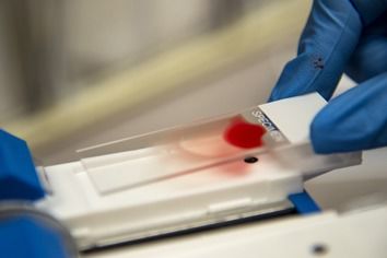 Ferritin 수치