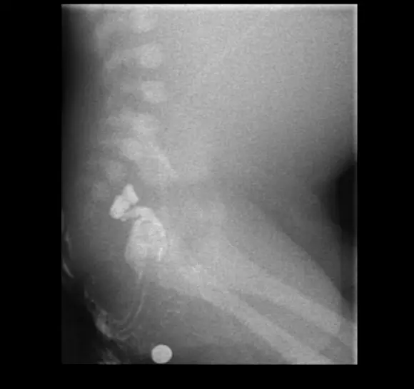  colon atresia로 인해 조영제가 recto-sigmoid 를 못넘어가는 모습