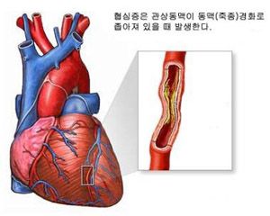 협심증 증상