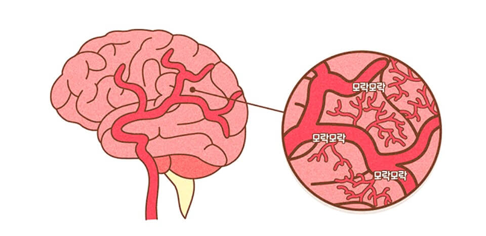 모야모야병 증상