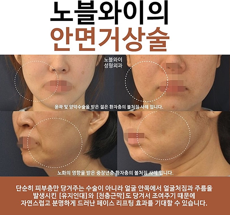  미니안면거상술후기 1년넘은게 없어?