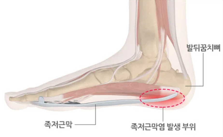 족저근막염