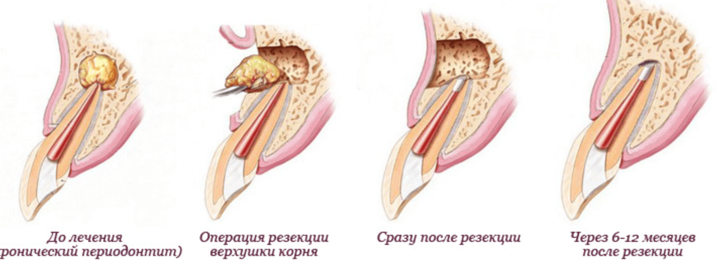 치근단절제술 과정