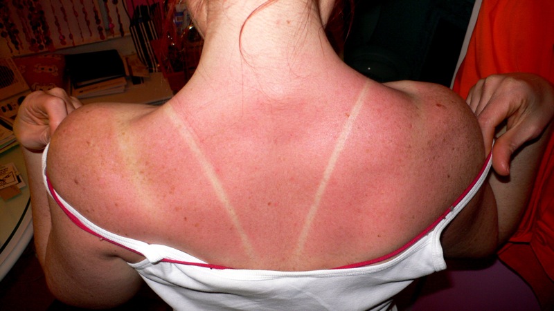  피부 탔을때, 썬번(sunburn)과 썬탠(suntan)