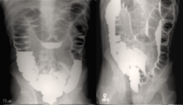  건강 보험 무료 대장 암 검진 - 대장 이중조영술(Colon Study) 검사 방법과 소요시간