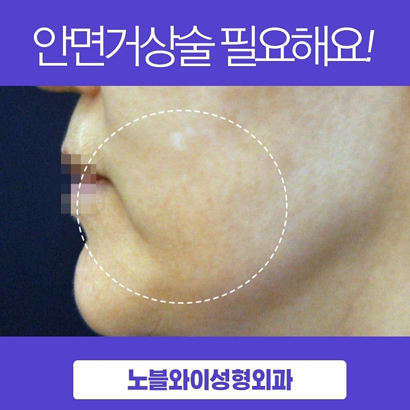  안면거상비용 유지기간 효과 체크