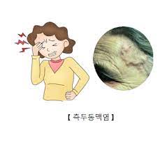 측두동맥염(Temporalarteritis)의 원인 및 증상 치료에 대하여
