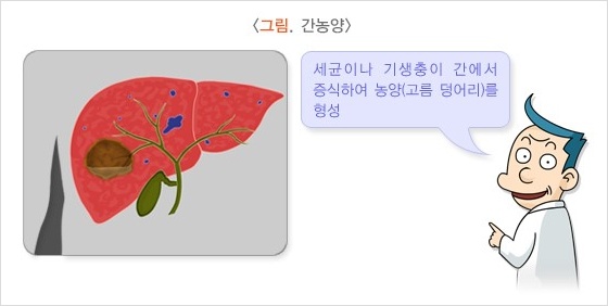 간농양 증상. 치료