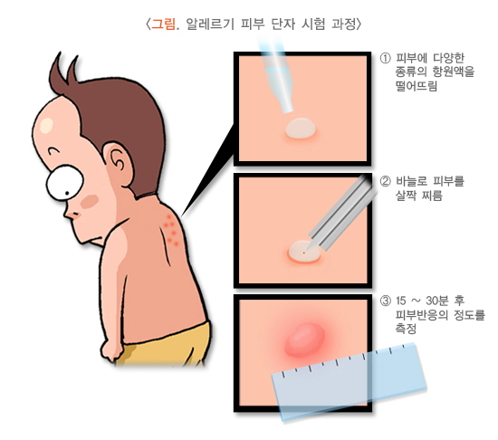 천식 치료