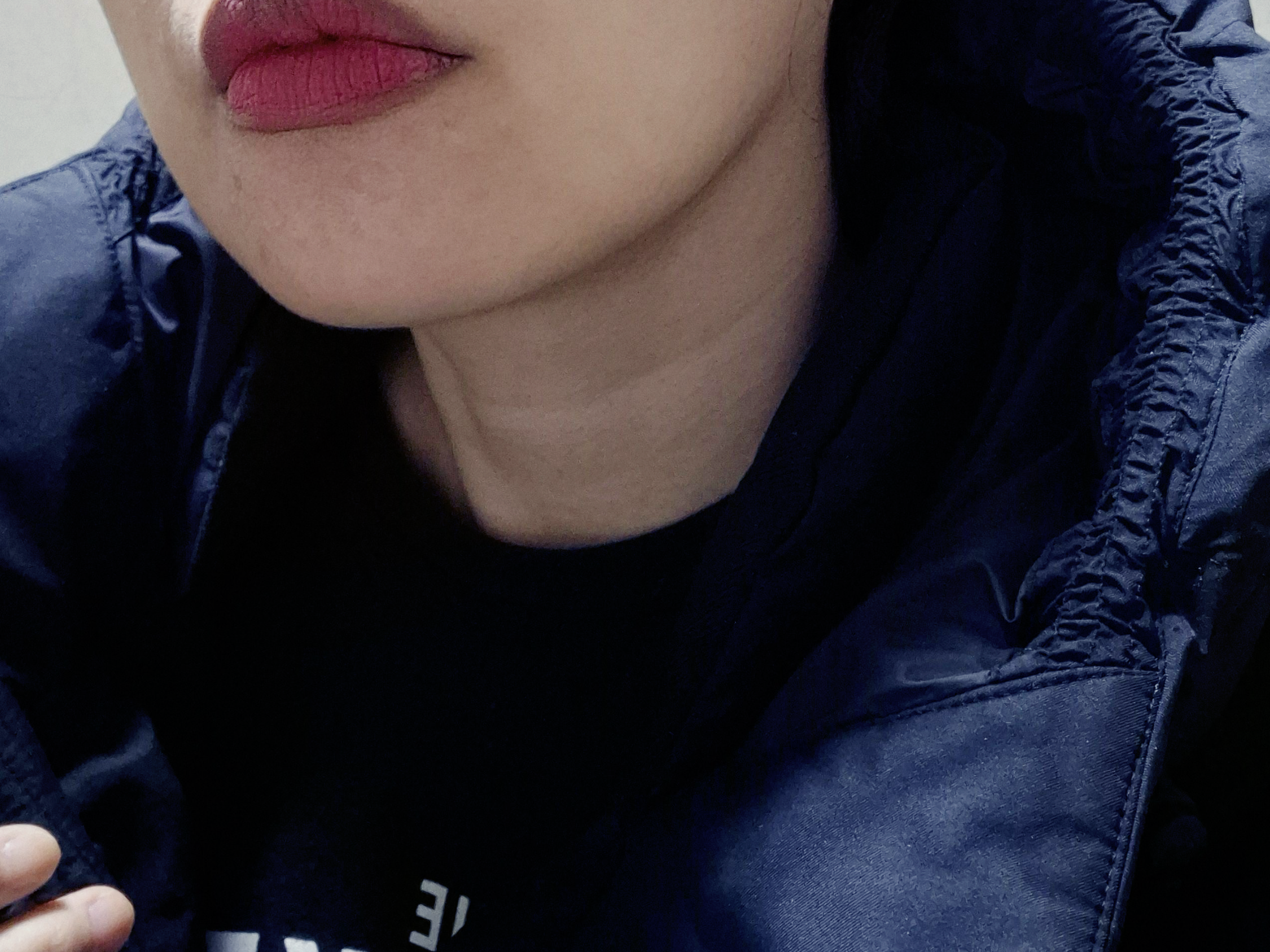의정부피부과 윤곽주사