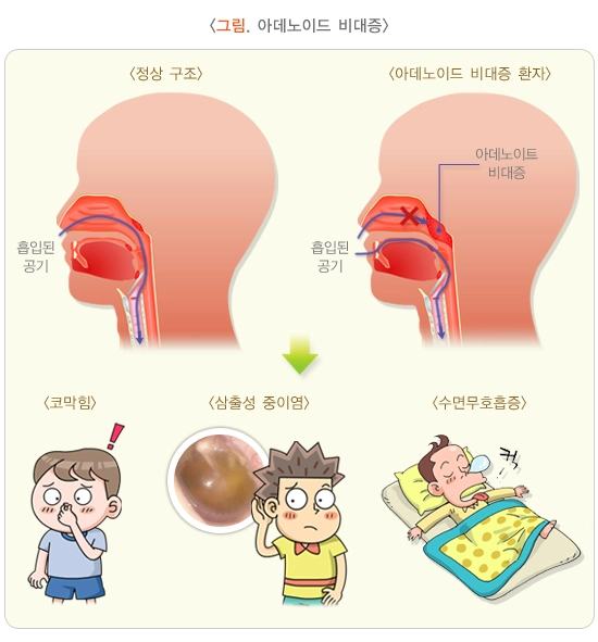 편도염의 원인&amp;#44; 증상&amp;#44; 치료법에 대한 정리