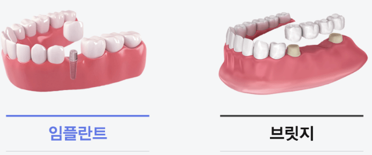 임플란트 가격 임플란트 종류 비교