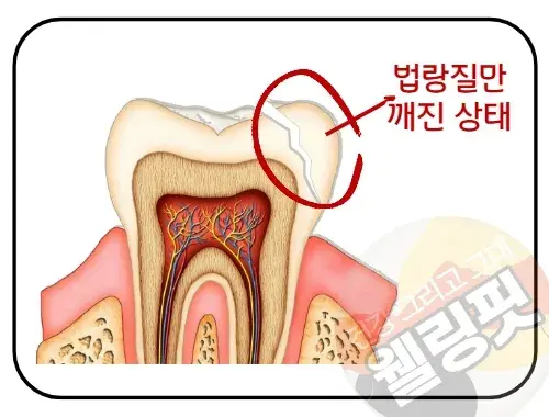 이빨-표면만-깨졌다면-비교적-쉽게-치료할-수-있습니다.