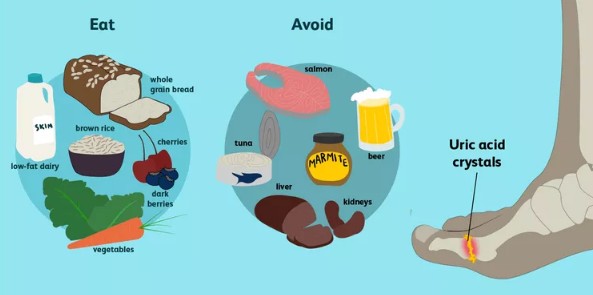 통풍환자 식단 - 통풍에 좋은 음식&#44; 나쁜음식