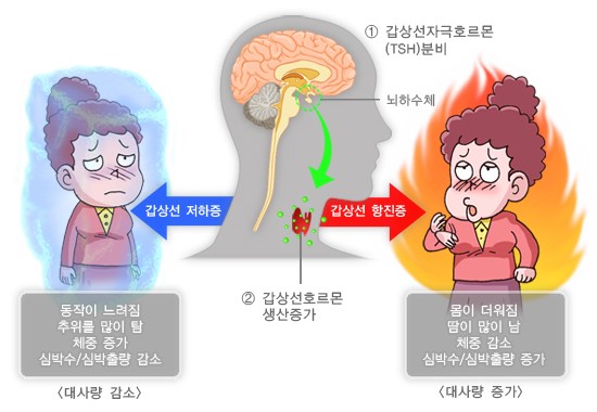 갑상선염의 증상