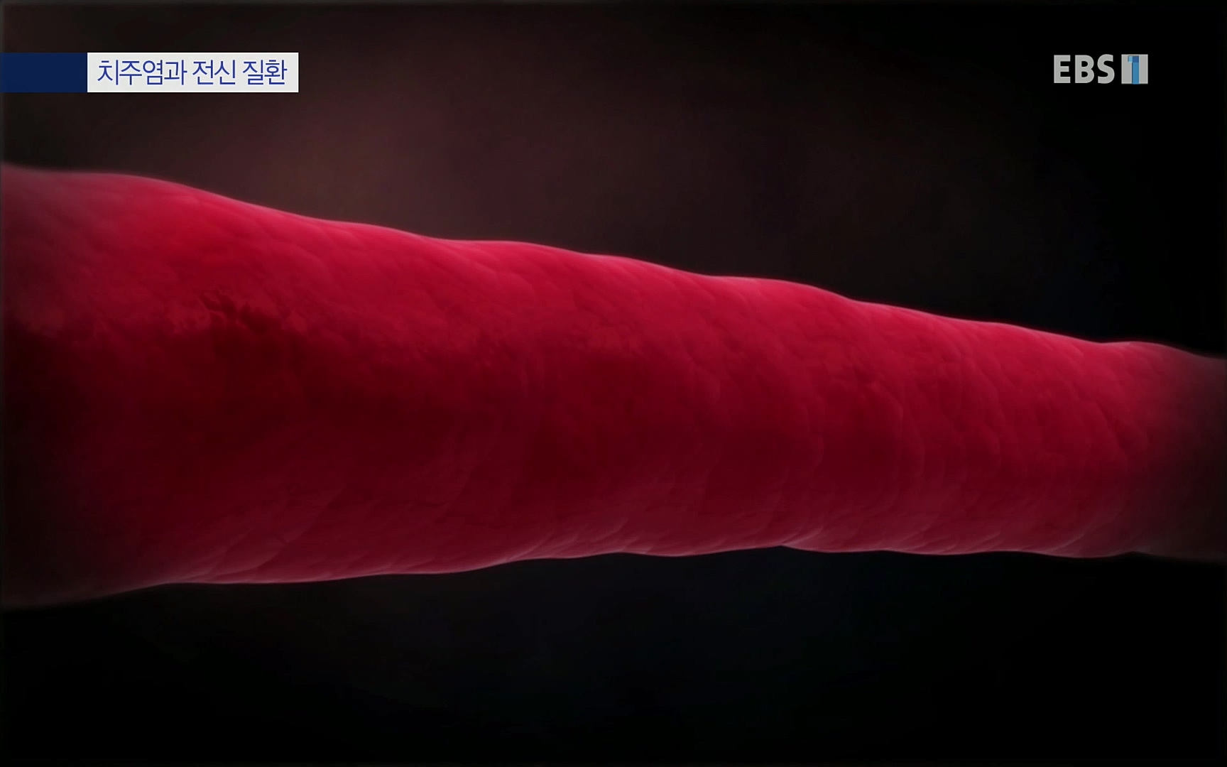 EBS 명의 헬스케어 - TV - 교육의 중심 EBS치주염이 코로나로 소홀해진 구강관리가 치아를 더 망가트리고 위험하게 만들며, 증상이 없기 때문에 특히 더 조심하고 치은염 단계에서 진행되지 않도록 예방해야한다 정의원 교수님과 치_20220505_151716.149.jpg