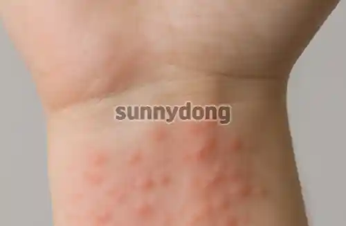 접촉성 피부염 증상 이미지