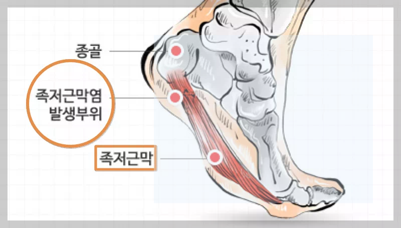 근저족막염