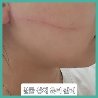 흉터전용 치료 추천 스카덤 겔 효능효과_8
