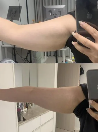 쥬비컷 팔뚝 슬리밍 랩핑 효과 직접 사용 후기와 방법 가격 분석_24